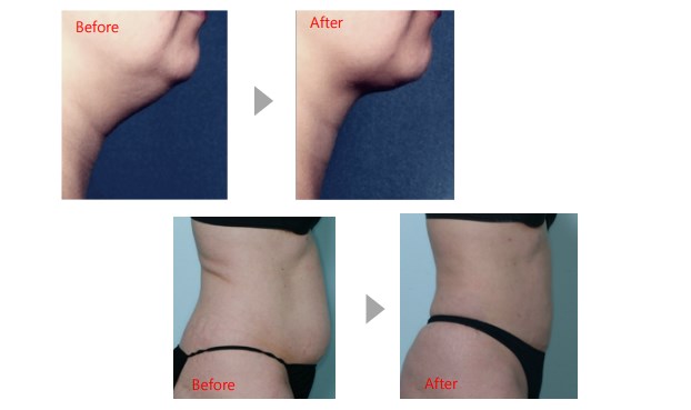 before & After Kabelline